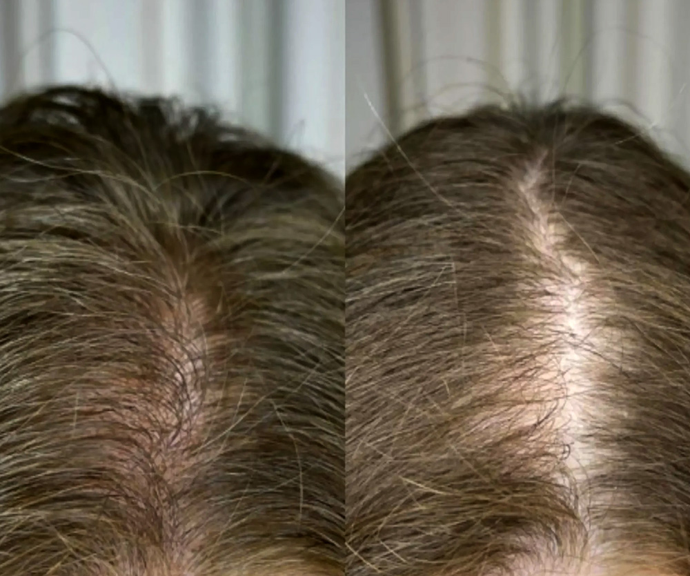 Micro Scalp Micro Scalp
